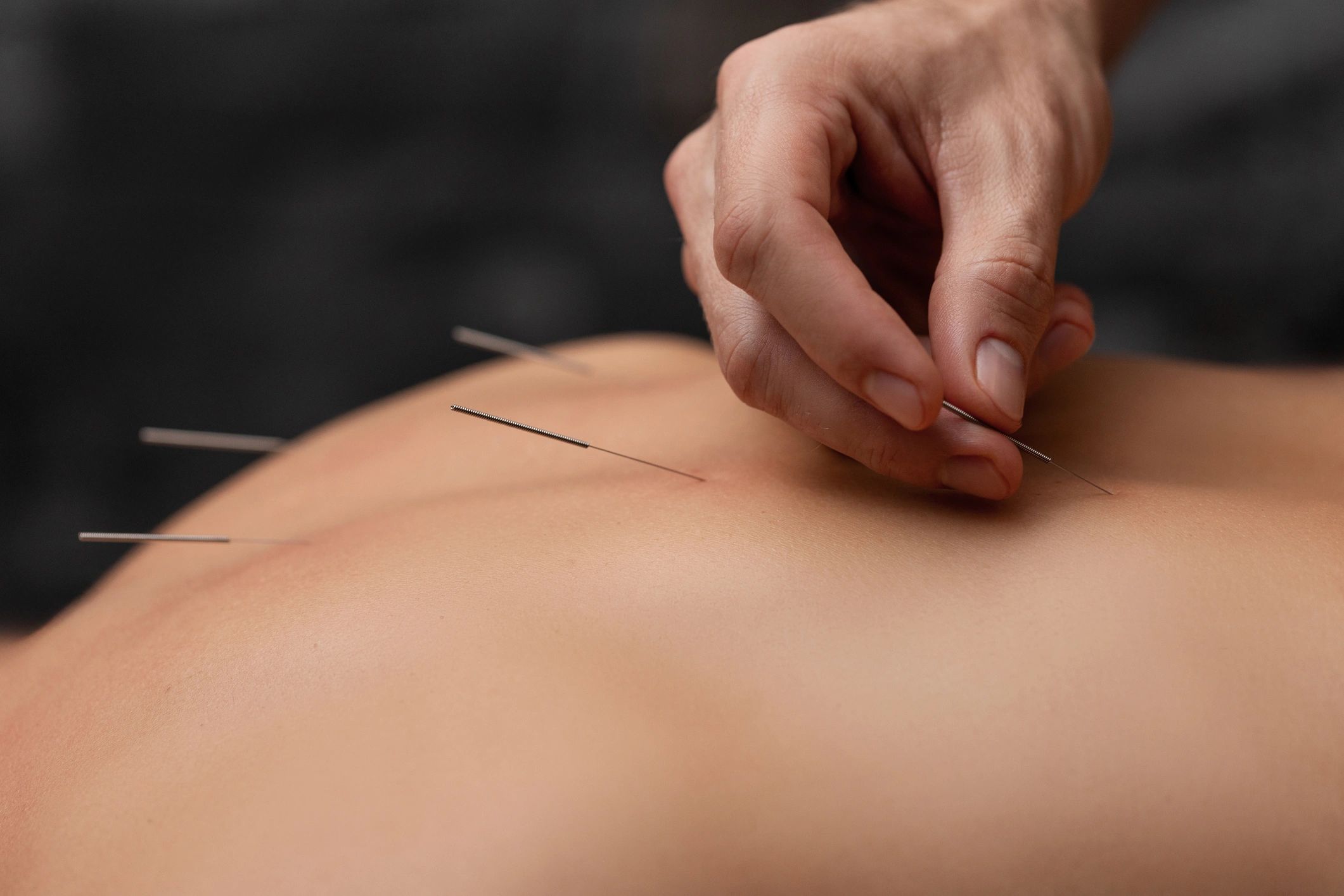 acupuncture treatment clinic