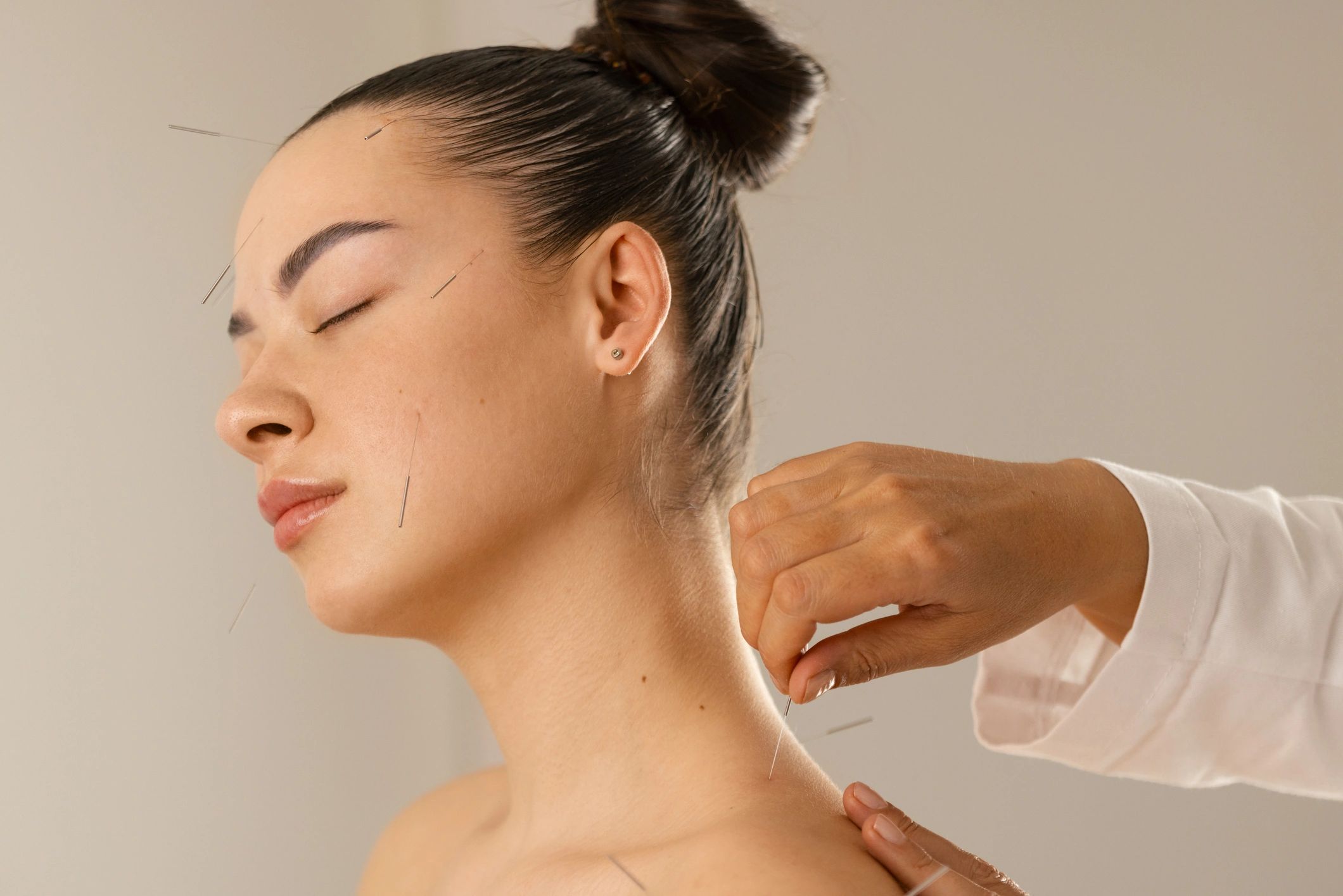 Acupuncture treatment in Bolton at The Arch Chiropractic